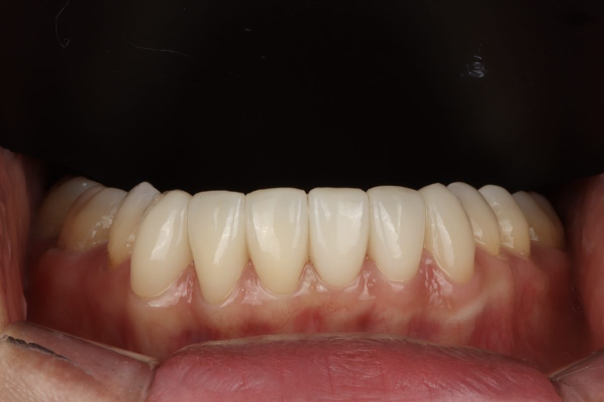 After porcelain veneers, case 1 – Blanche Dental Clinic, Gangnam