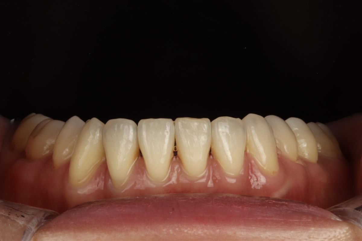 Before veneers, case 1 – Blanche Dental Clinic, Gangnam