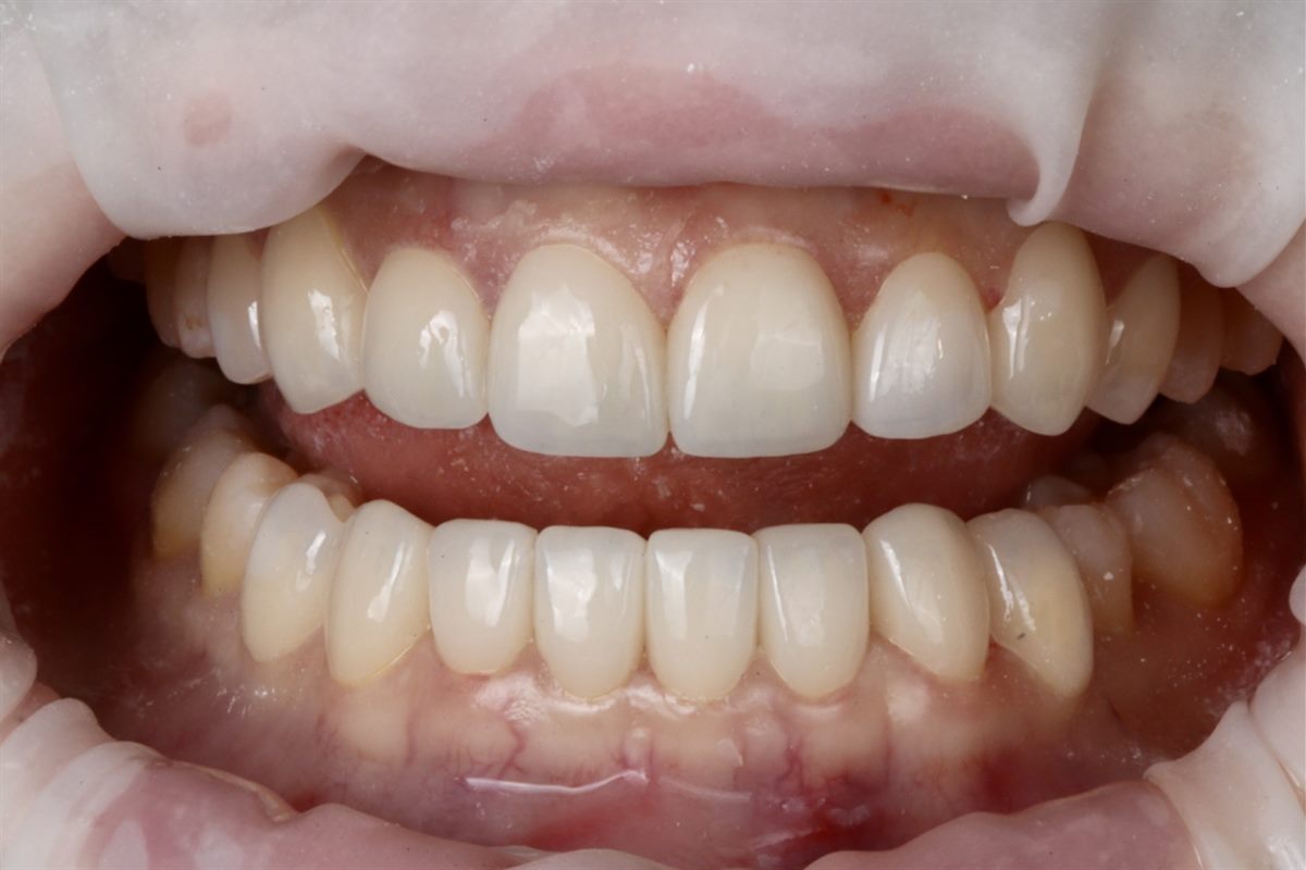 After porcelain veneers, case 2 – Blanche Dental Clinic, Gangnam