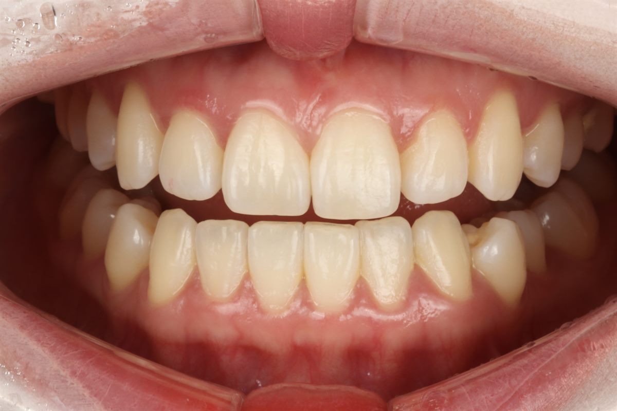 Before veneers, case 2 – Blanche Dental Clinic, Gangnam