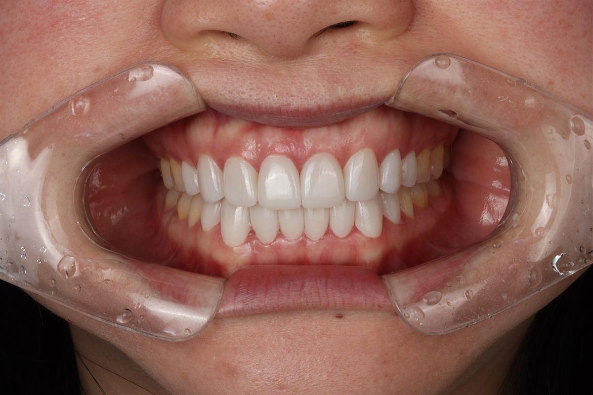 After porcelain veneers, case 3 – Blanche Dental Clinic, Gangnam