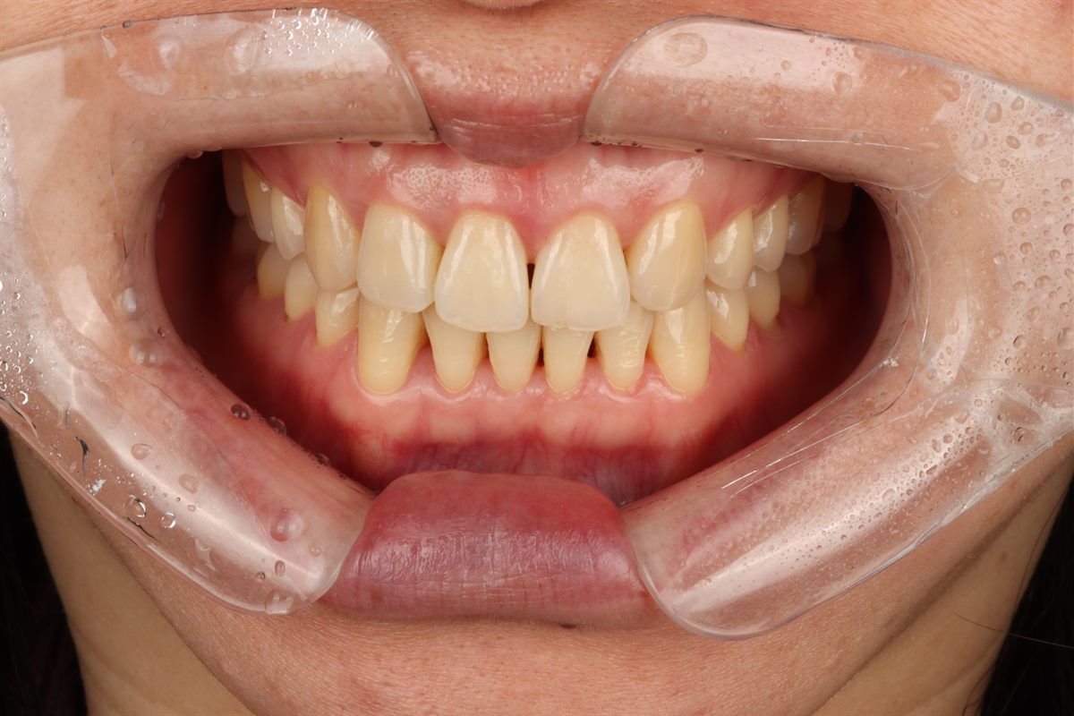 Before veneers, case 3 – Blanche Dental Clinic, Gangnam