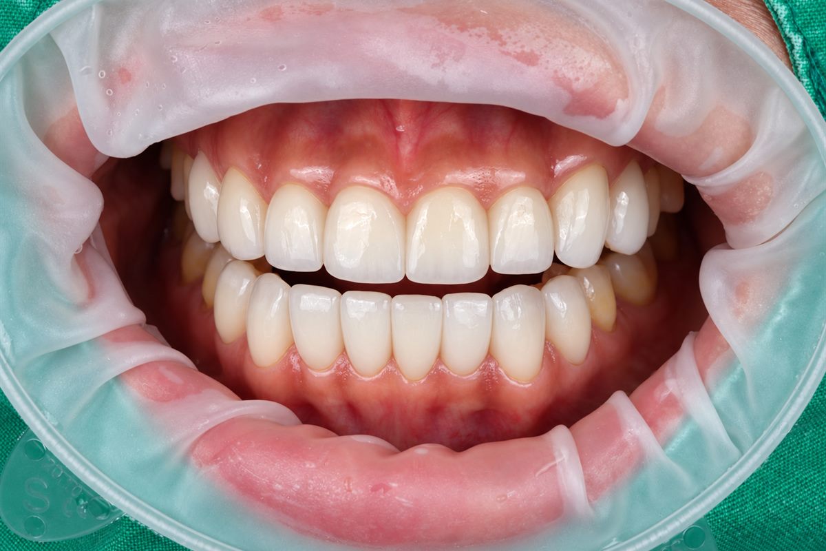 After porcelain veneers, case 4 – Blanche Dental Clinic, Gangnam