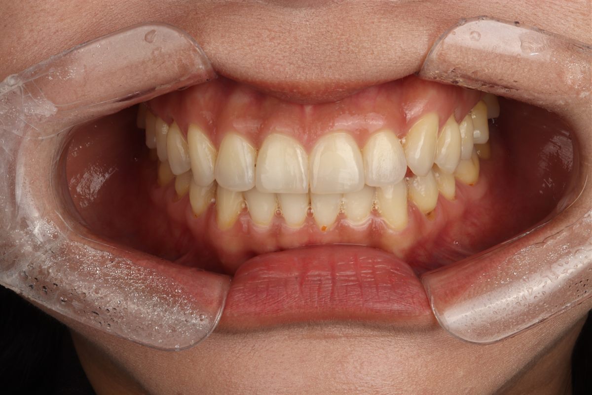 Before veneers, case 4 – Blanche Dental Clinic, Gangnam