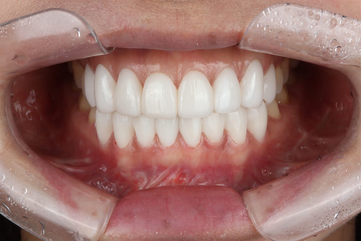 After porcelain veneers, case 5 – Blanche Dental Clinic, Gangnam