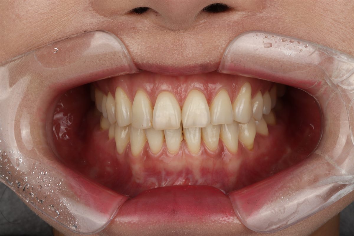 Before veneers, case 5 – Blanche Dental Clinic, Gangnam