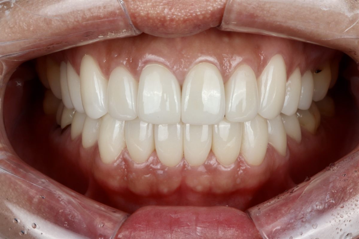 After porcelain veneers, case 6 – Blanche Dental Clinic, Gangnam