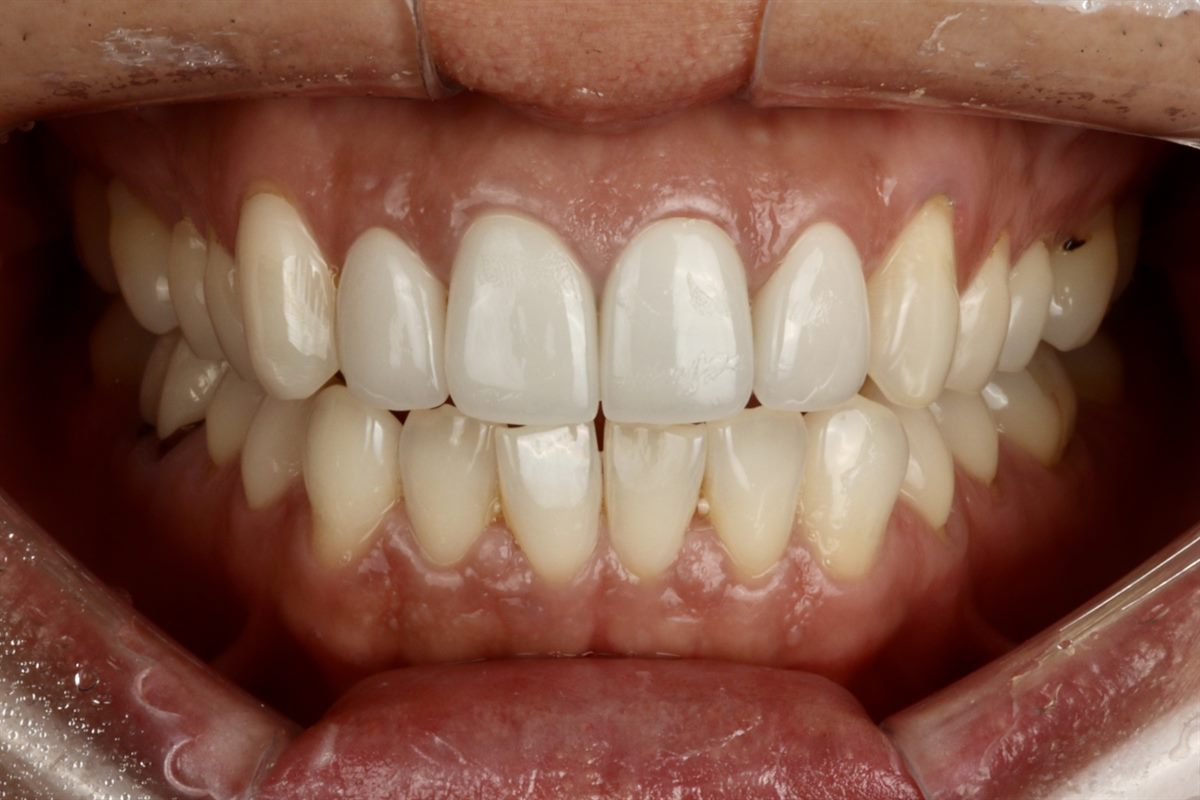 Before veneers, case 6 – Blanche Dental Clinic, Gangnam