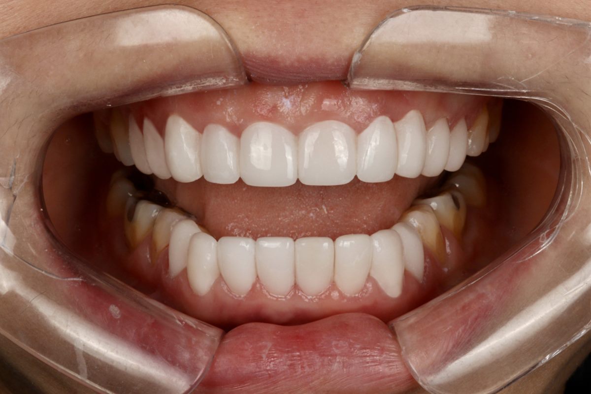 After porcelain veneers, case 7 – Blanche Dental Clinic, Gangnam