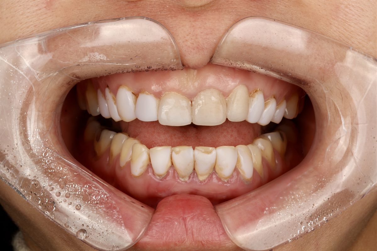 Before veneers, case 7 – Blanche Dental Clinic, Gangnam