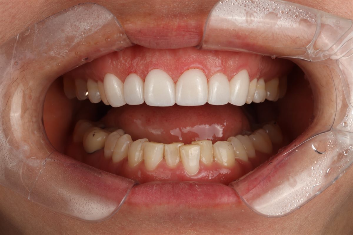 After porcelain veneers, case 8 – Blanche Dental Clinic, Gangnam