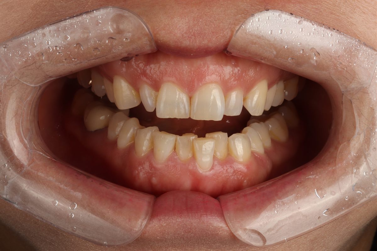 Before veneers, case 8 – Blanche Dental Clinic, Gangnam