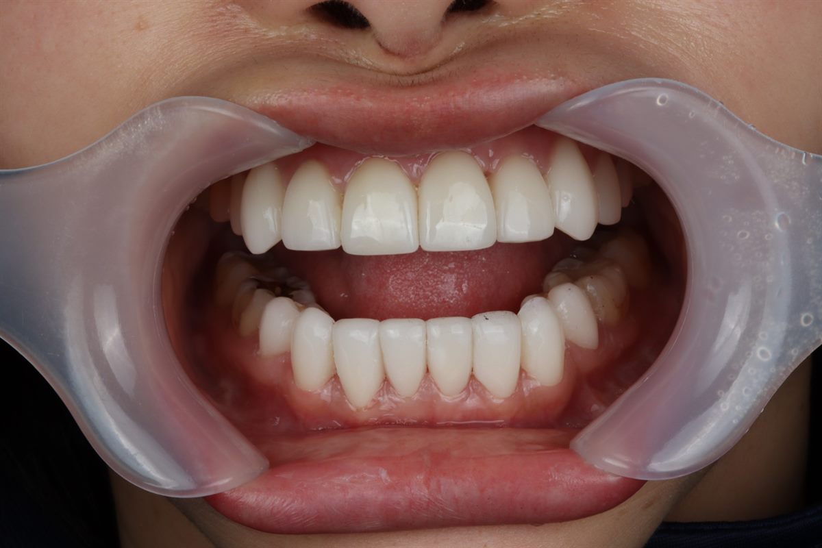 Lower front teeth after no-prep veneers – Blanche Dental Clinic, Gangnam