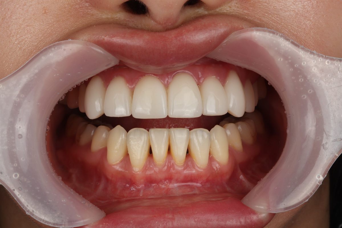 Lower front teeth before no-prep veneers – Blanche Dental Clinic, Gangnam